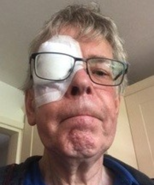 A selfie-style photo of Jim, taken from below face level. They are wearing rectangular black-framed glasses. A white eye patch covers their left eye, and their mouth is turned downward.